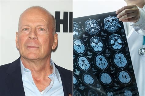 what is bruce willis sickness